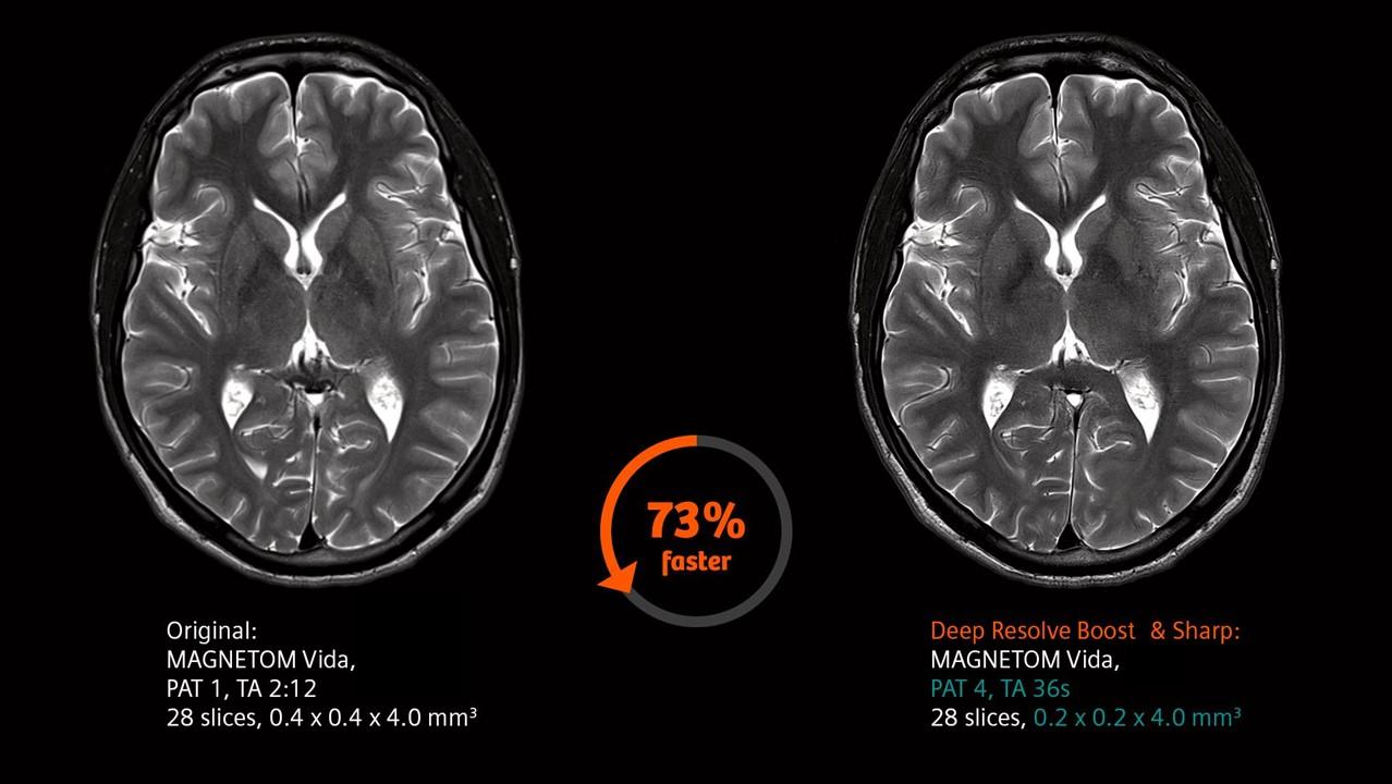 MRI Acceleration