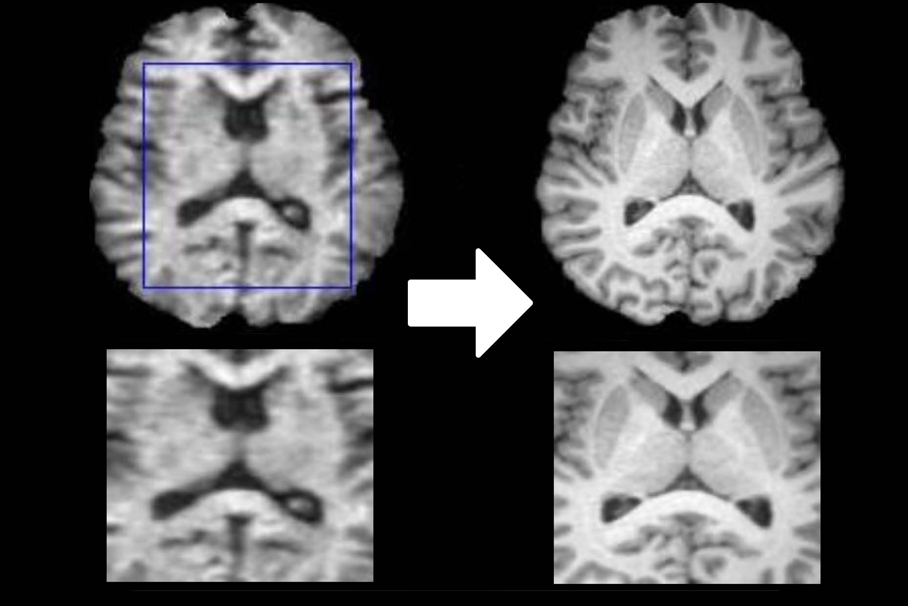 MRI Enhancement